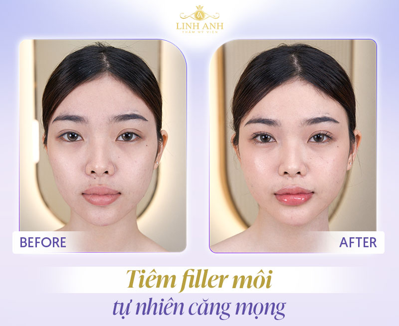 Hình ảnh tiêm filler môi e.p.t.q