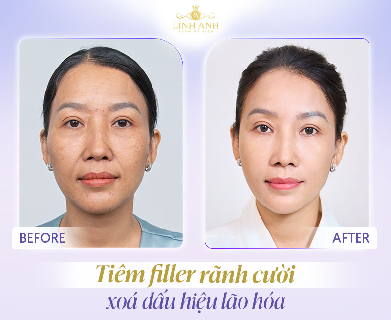 Hình ảnh tiêm filler rãnh cười e.p.t.q