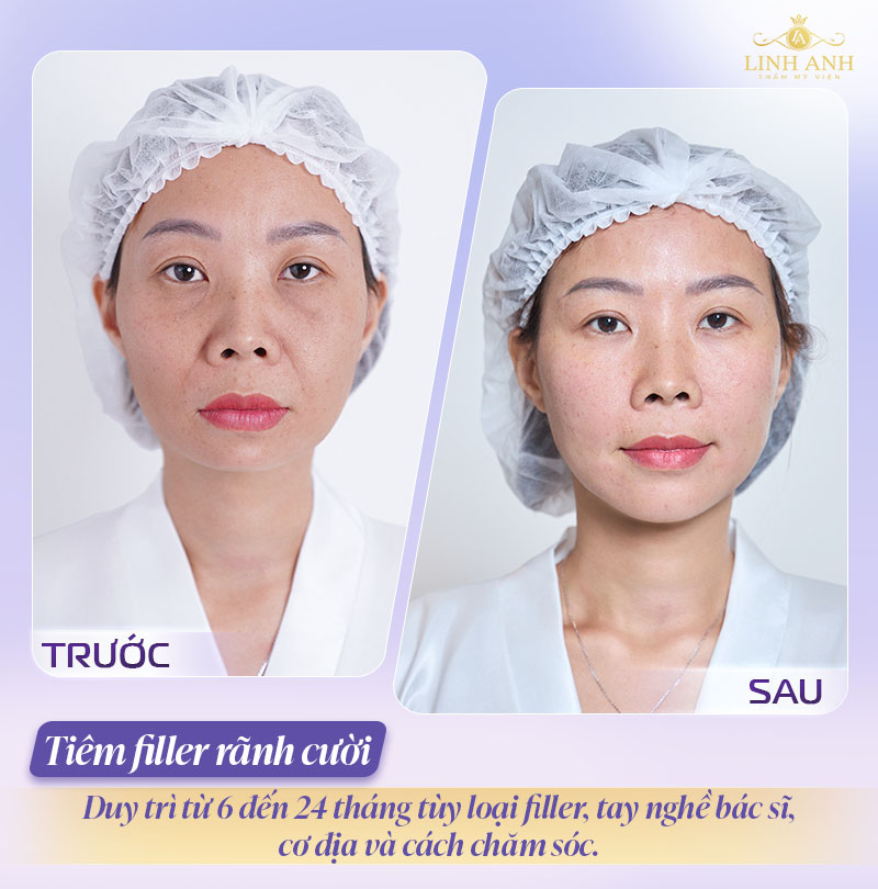 Hình ảnh tiêm filler rãnh cười