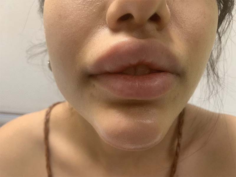Hình ảnh Tiêm filler sau 1 năm bị sưng