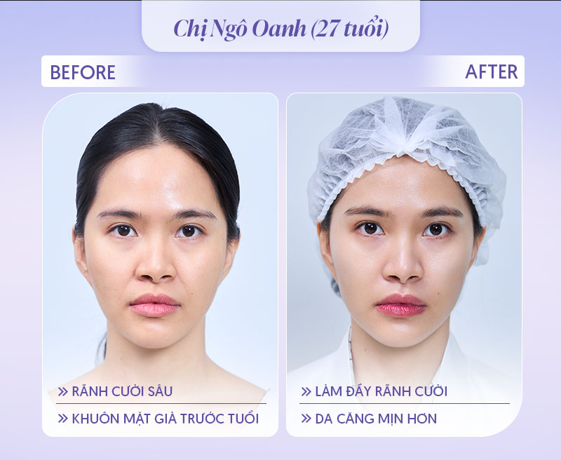 Hình ảnh tiêm rãnh cười