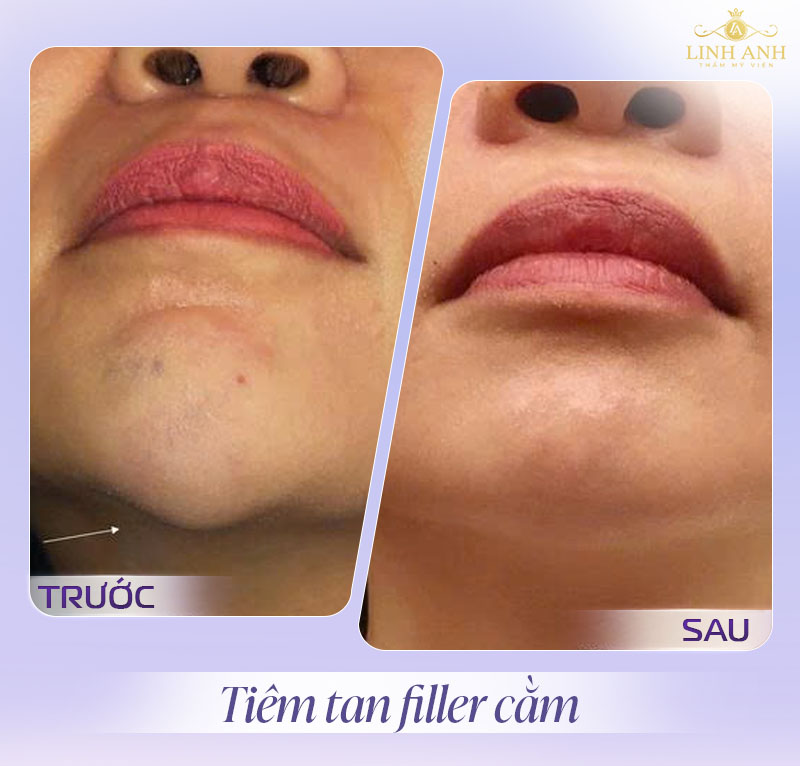 Hình ảnh tiêm tan filler cằm