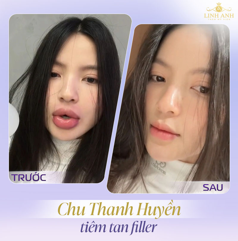 Hình ảnh tiêm tan filler môi