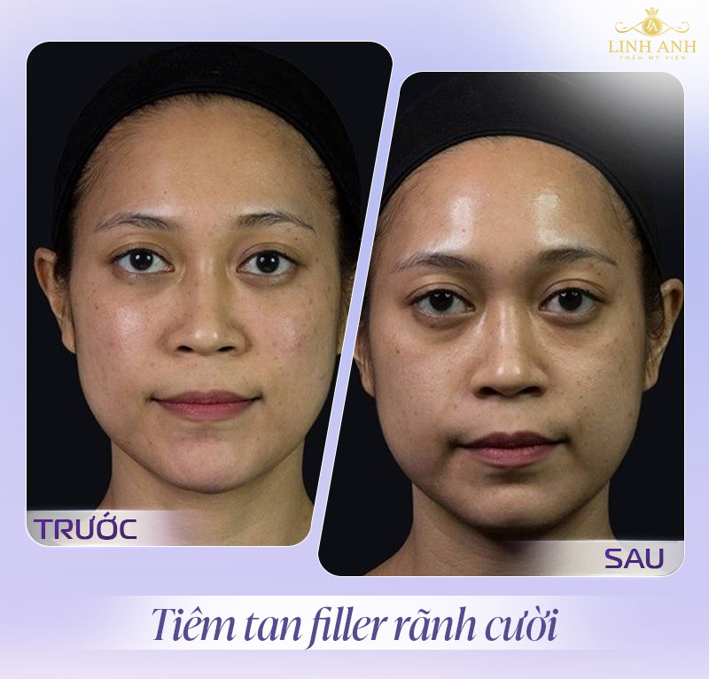 Hình ảnh tiêm tan filler rãnh cười