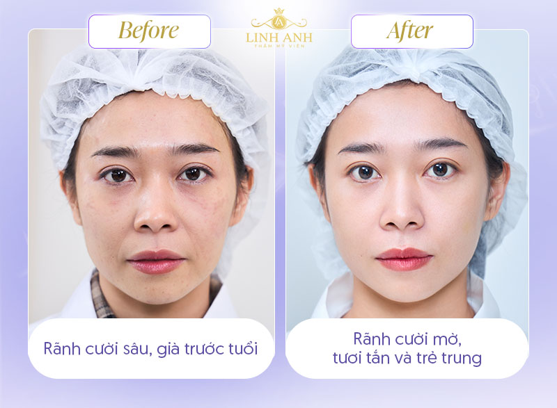 Hình ảnh trước và sau tiêm filler rãnh cười