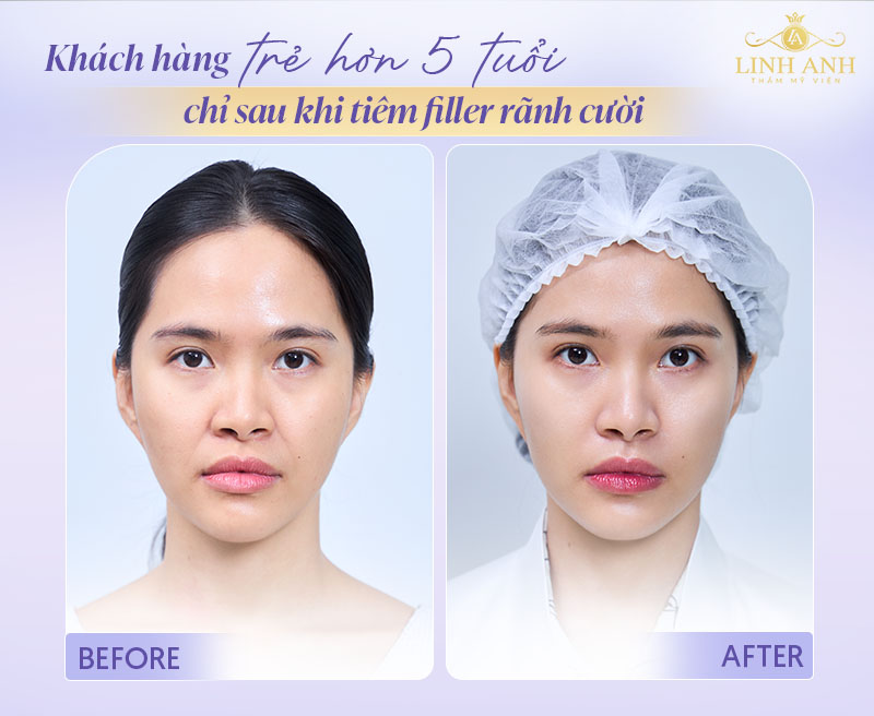 Hình ảnh trước và sau khi tiêm rảnh cười - Phòng khám thẩm mỹ Linh Anh