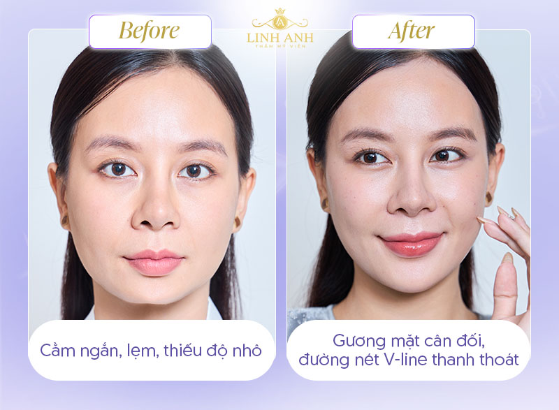 Hình ảnh trước và sau tiêm filler Cằm