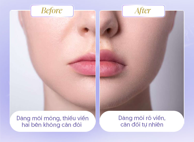 Hình ảnh trước và sau tiêm filler Môi