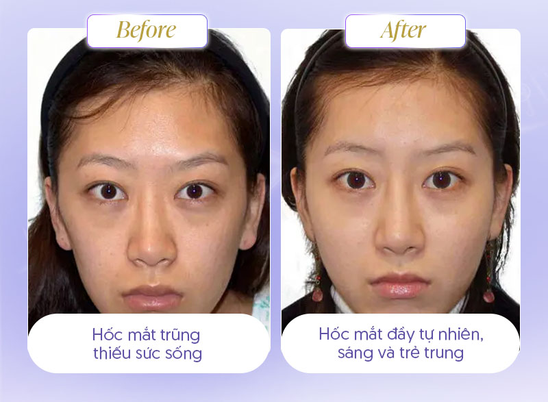 Hình ảnh trước và sau tiêm filler trũng mắt