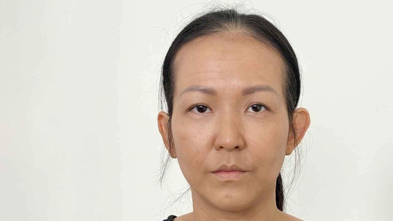 Khắc phục thái dương hóp