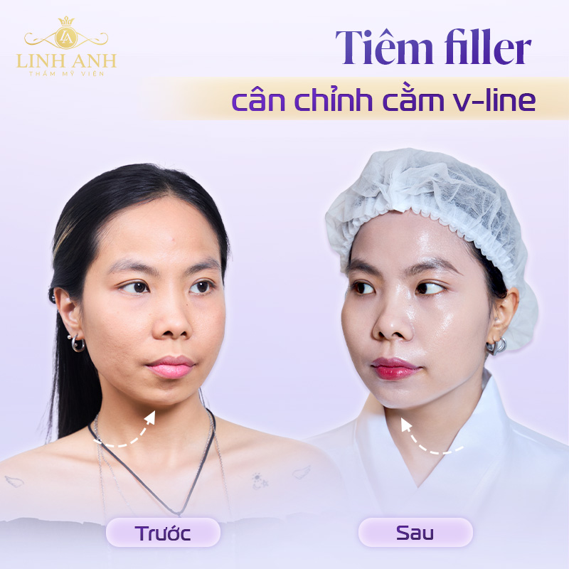 Khách hàng tiêm filler cằm V line