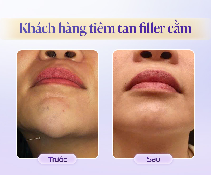 Khách hàng tiêm tan filler cằm
