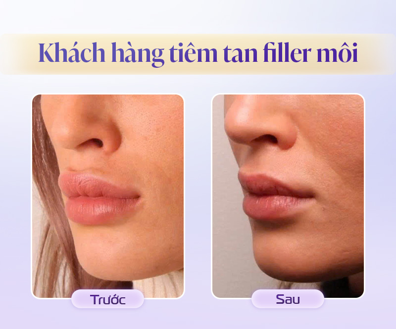 Khách hàng tiêm tan filler môi tại Linh Anh
