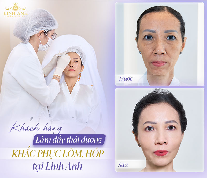 Làm đầy thái dương chuẩn y khoa
