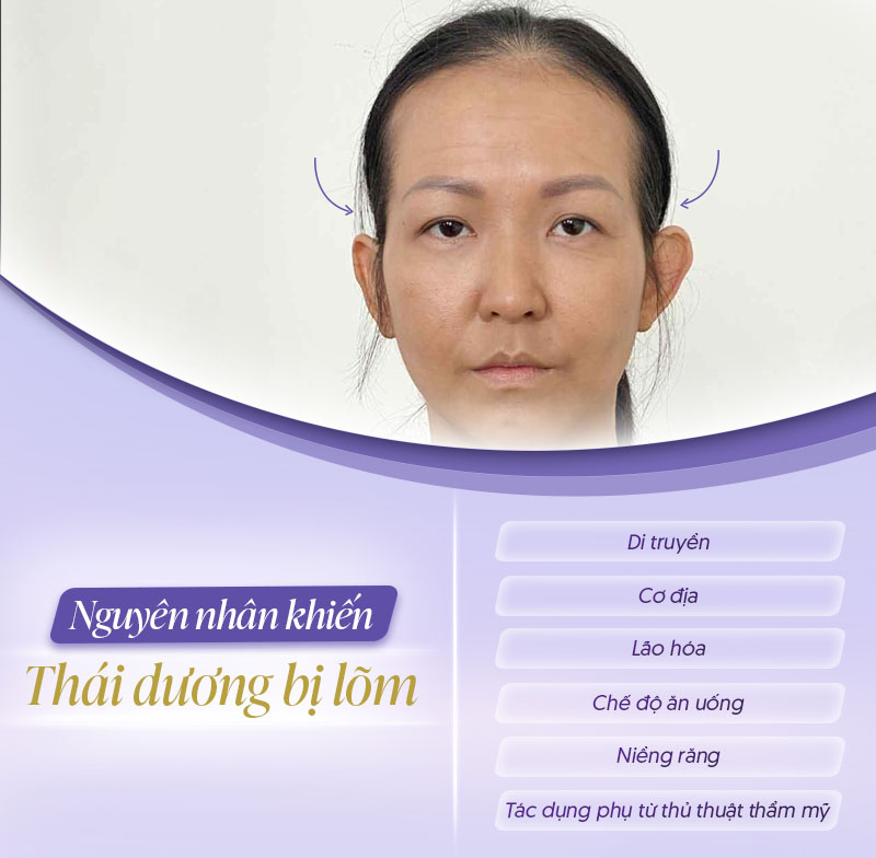 Lõm thái dương