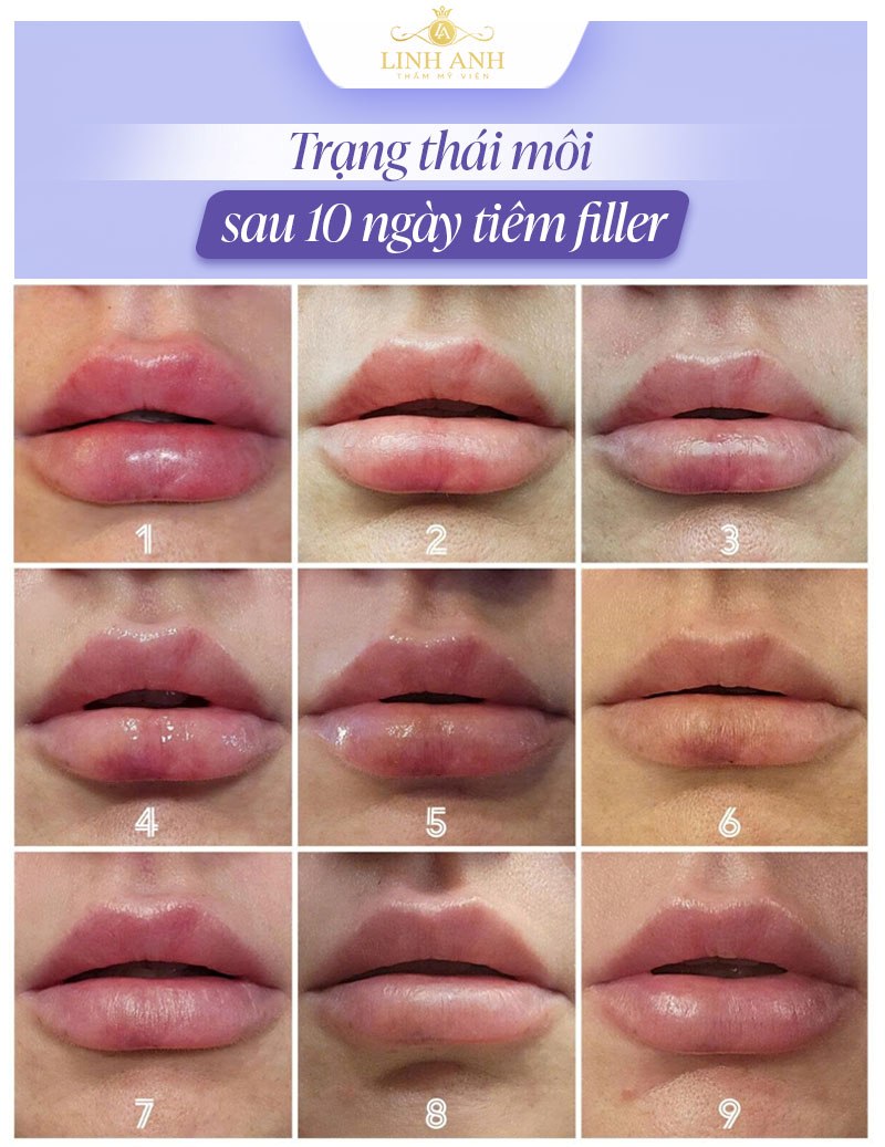 Hình ảnh môi sau tiêm filler 10 ngày