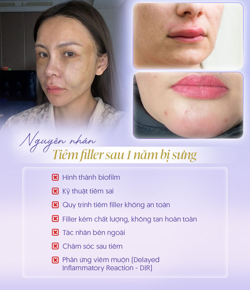 Nguyên nhân tiêm filler sau 1 năm bị sưng