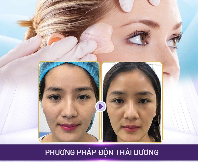 Phẫu thuật độn thái dương