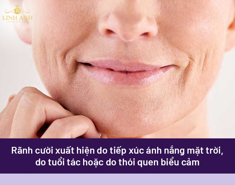Nguyên nhân gây nên rãnh cười sâu
