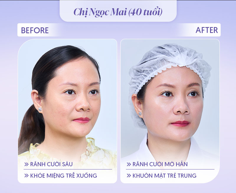 Review tiêm rãnh cười