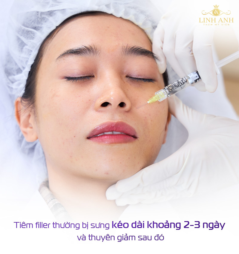 Sau tiêm filler bao lâu thì hết sưng