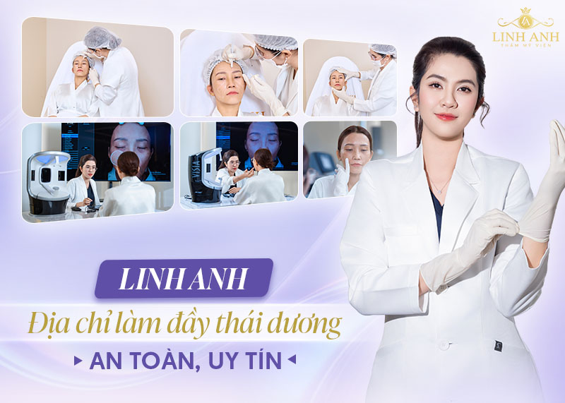 Sau tiêm filler thái dương cần kiêng gì