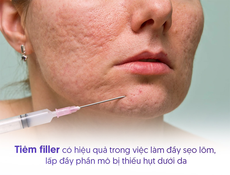 Sẹo lõm có tiêm filler được không