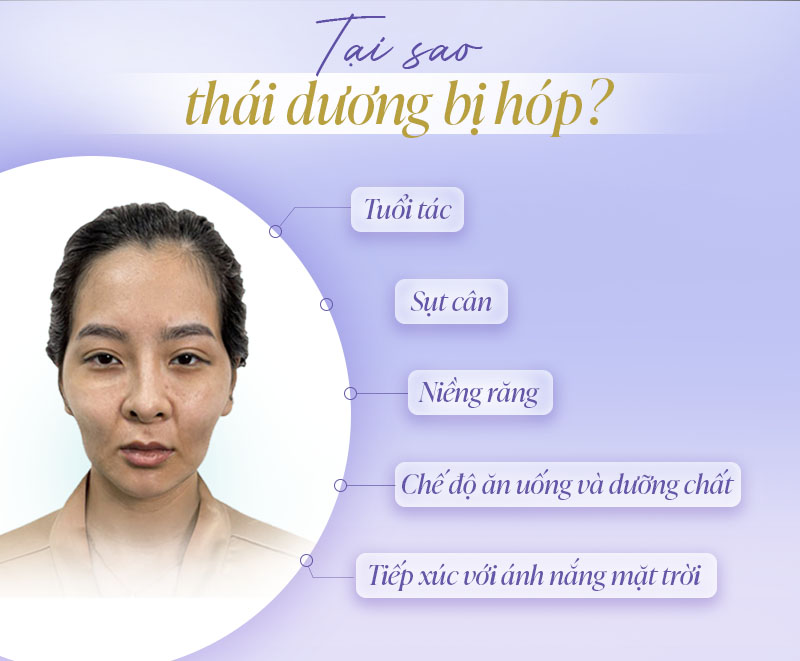 Tại sao thái dương bị hóp