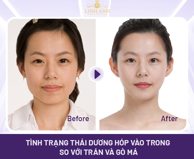 Thái dương hóp