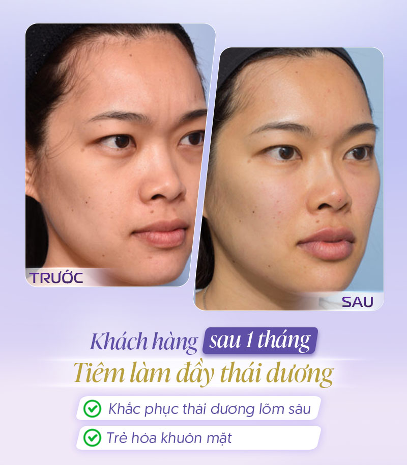 Tiêm đầy thái dương sau 1 tháng