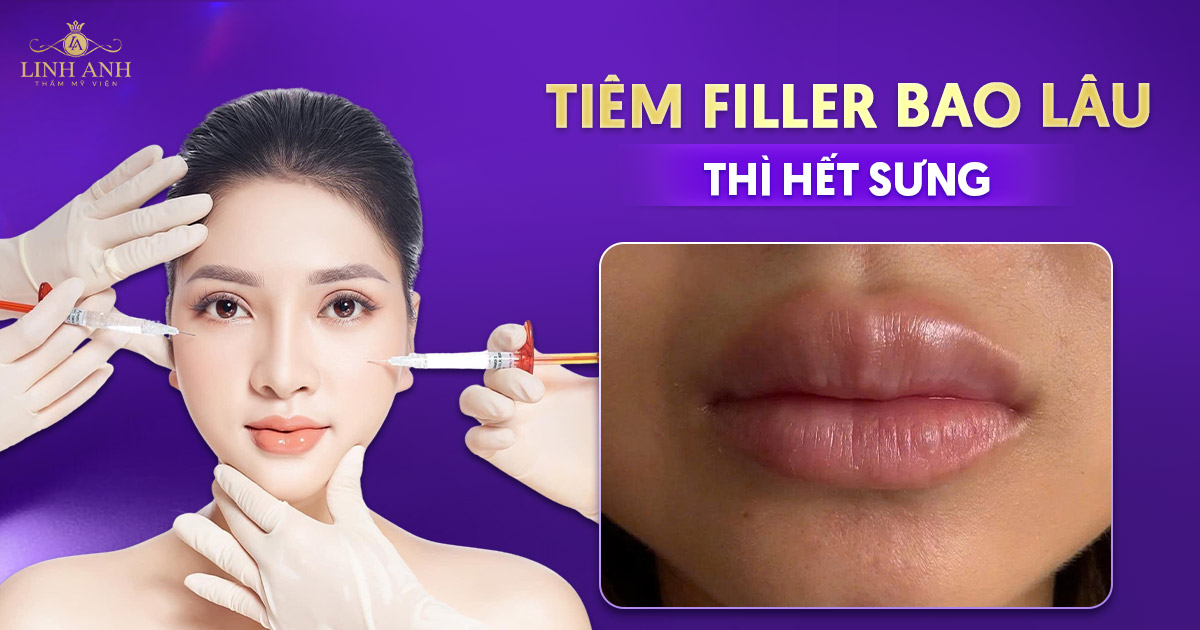 Tiêm filler bao lâu thì hết sưng? Yếu tố ảnh hưởng thời gian sưng