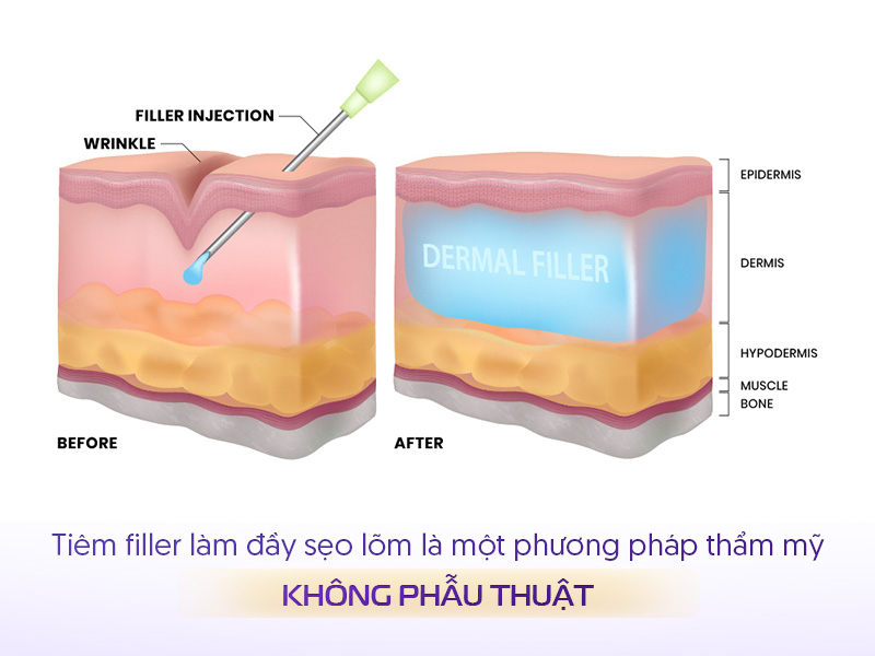 Tiêm filler đầy sẹo lõm