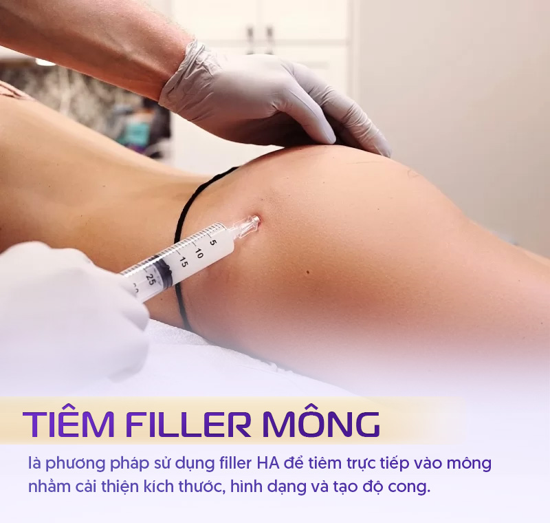 Tiêm filler hõm mông
