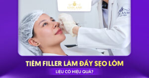 Tiêm filler làm đầy sẹo lõm