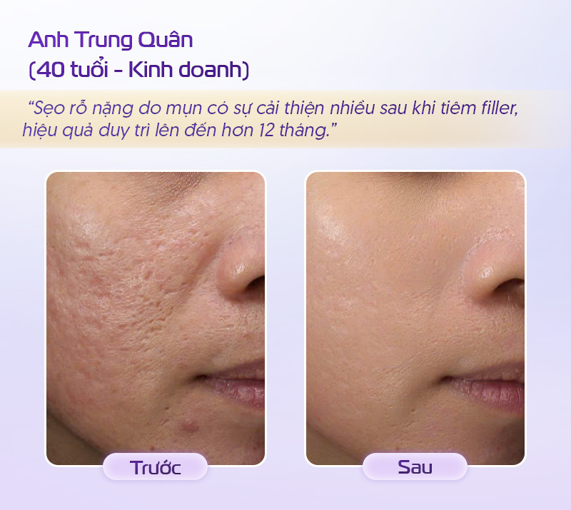 Tiêm filler làm đầy sẹo rỗ