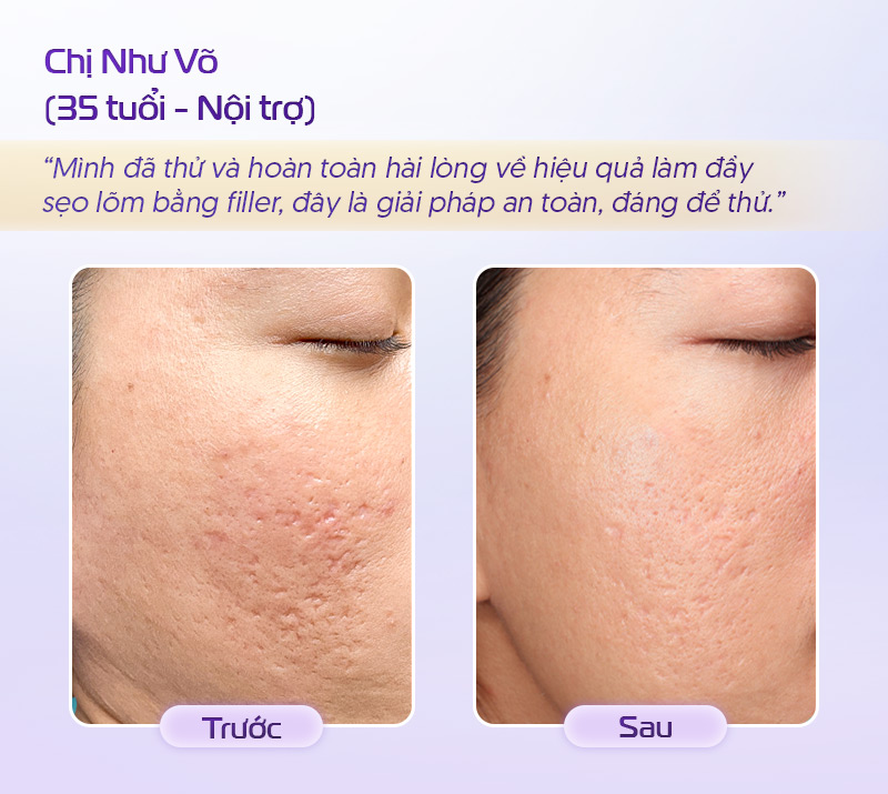 Tiêm filler làm đầy sẹo