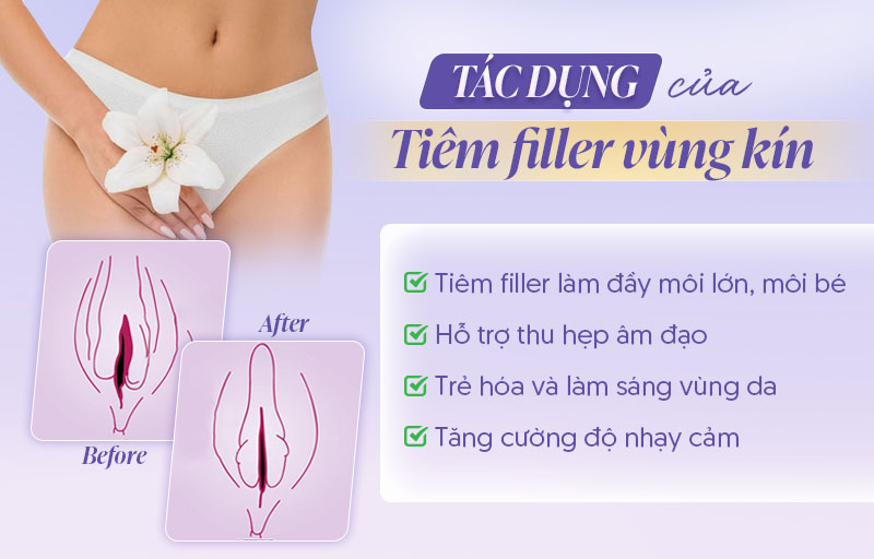 Tiêm filler làm đầy vùng kín