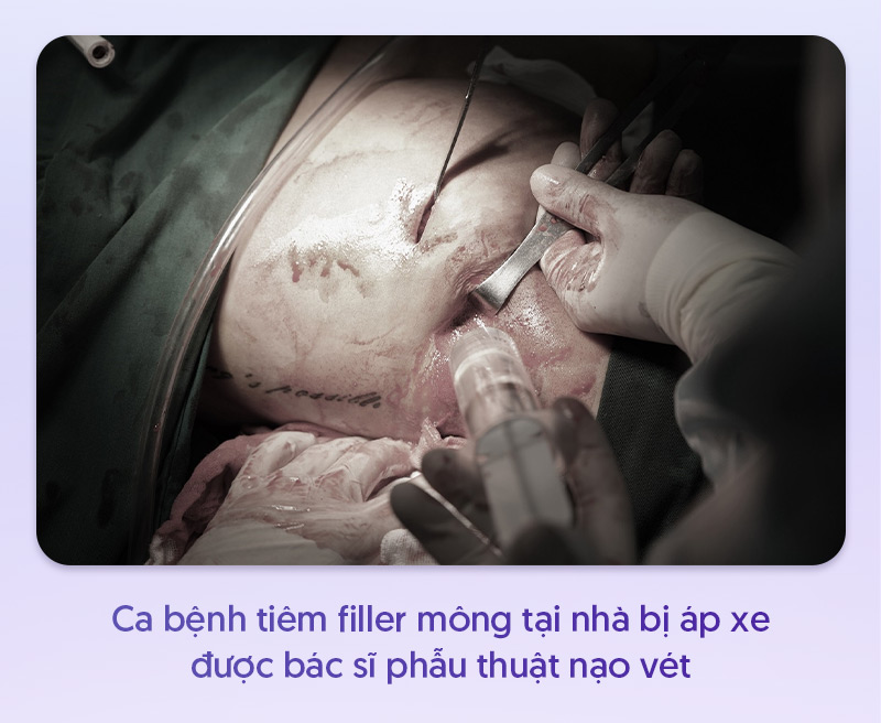 Tiêm filler mông bị áp xe