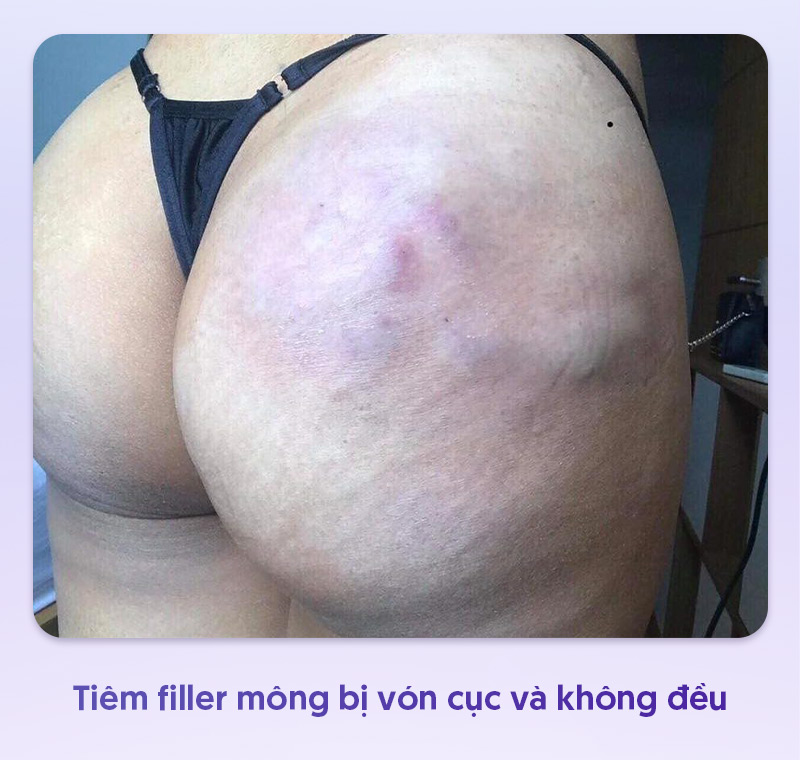 Tiêm filler mông bị cứng