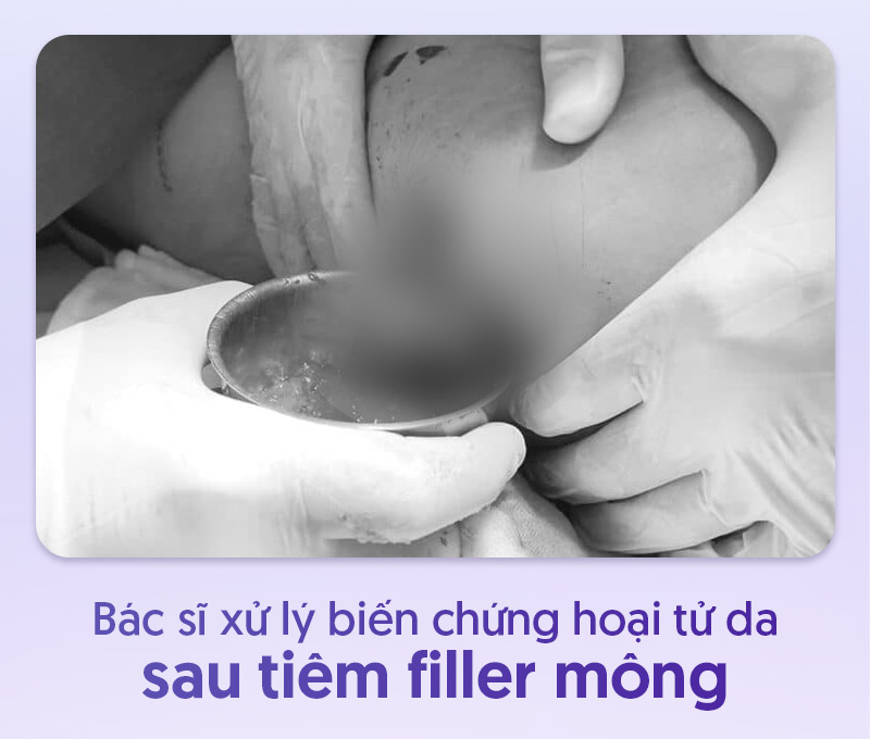 Tiêm filler mông bị hoại tử