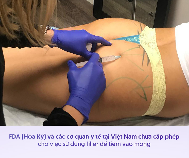Tiêm filler mông có hại không