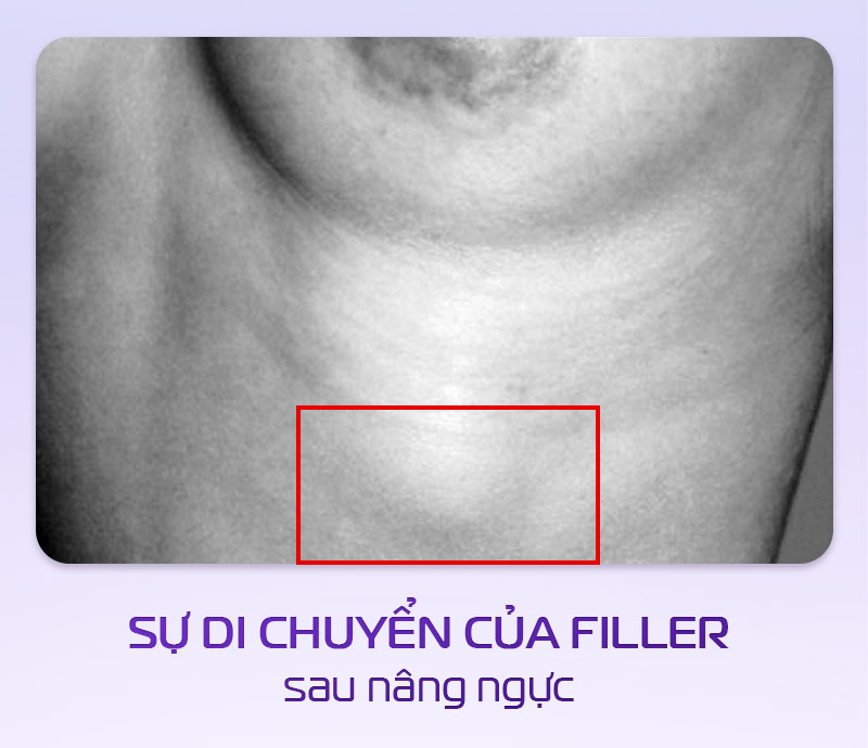 Tiêm filler ngực có nguy hiểm không