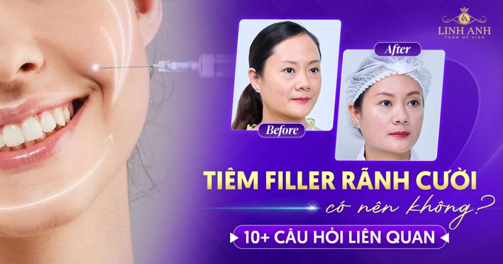 Tiêm filler rãnh cười