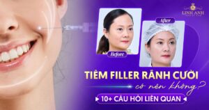 Tiêm filler rãnh cười