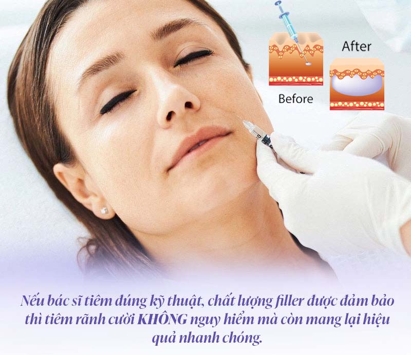 Tiêm filler rãnh cười có nguy hiểm không