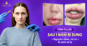 Tiêm filler sau 1 năm bị sưng
