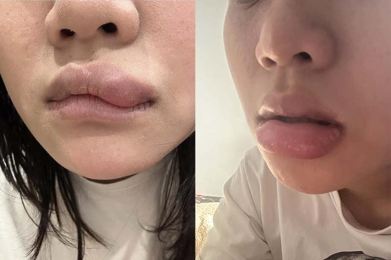 Tiêm filler sau 1 năm bị sưng đau