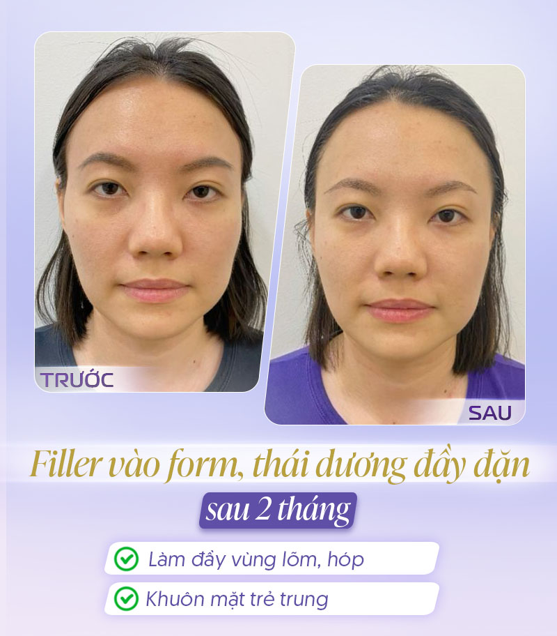 Tiêm filler Thái dương sau 2 tháng
