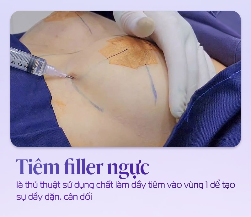 Tiêm filler vào ngực