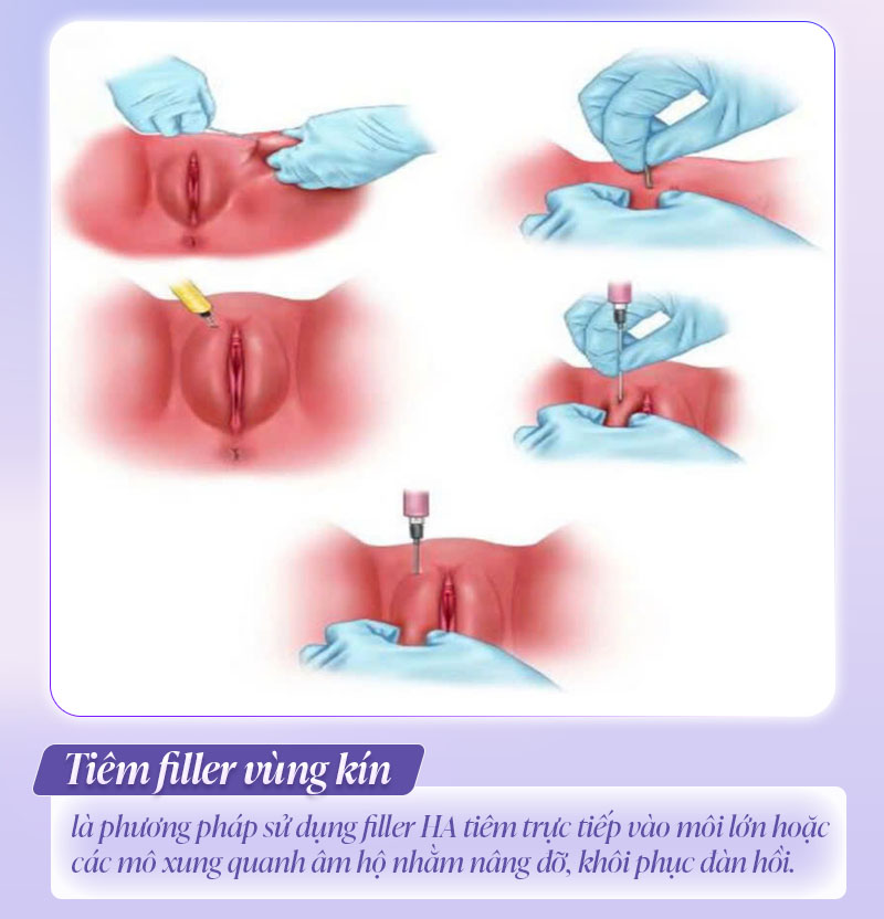 Tiêm filler vùng kín là gì